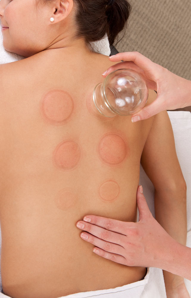 Cupping
