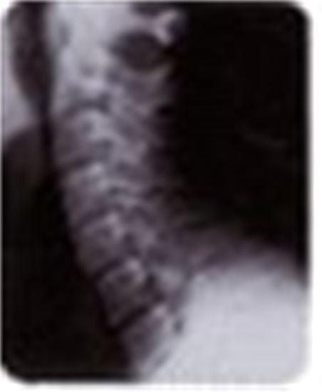 "Normal" 75-Year-Old Cervical Spine